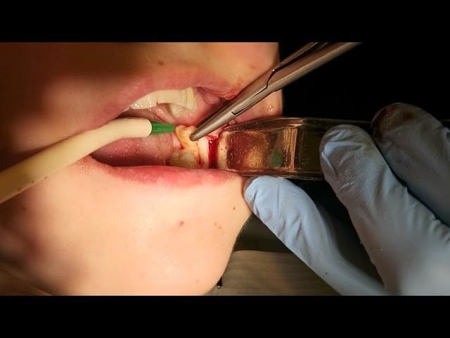 Surgical wisdom tooth extraction