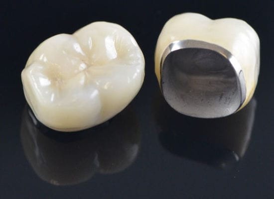 Porcelain Crown (German)