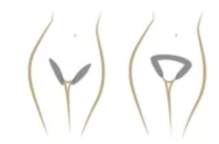 Standard bikini line
