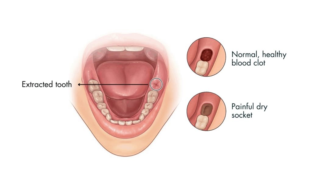 Dry socket per session