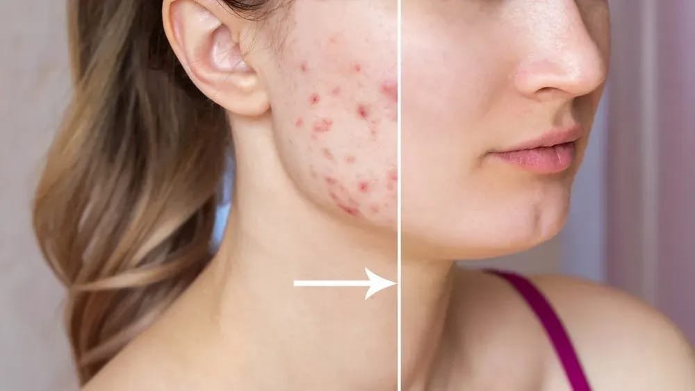 Acne Peel