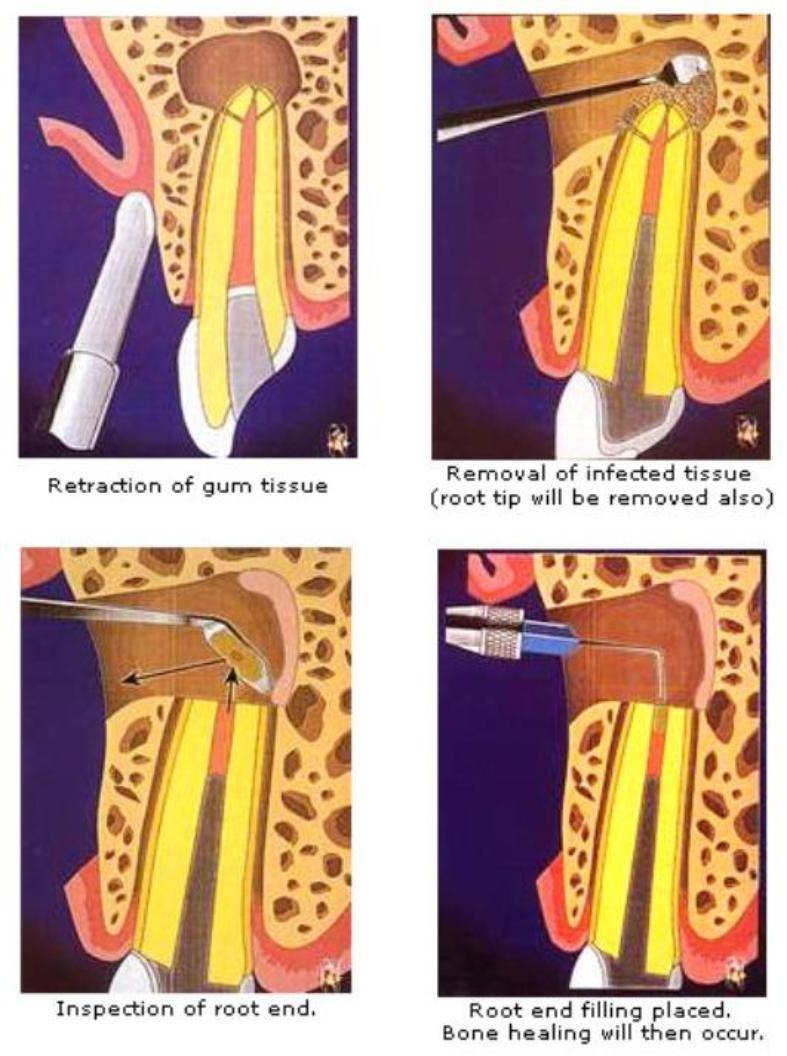 Apicectomy