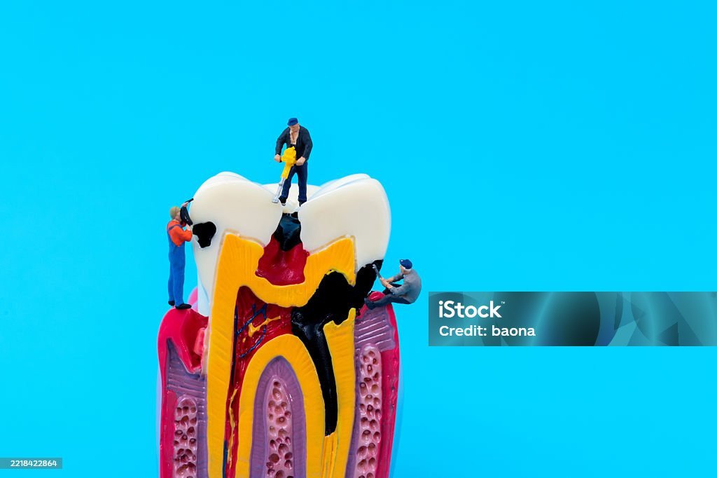 Root Canal