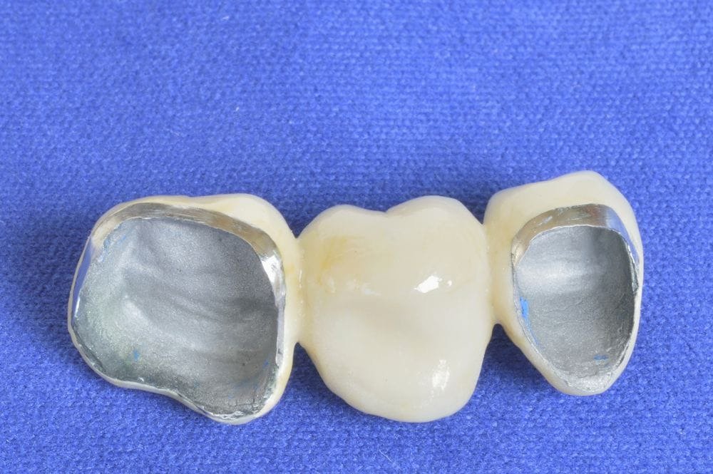 Zirconia/Porclein