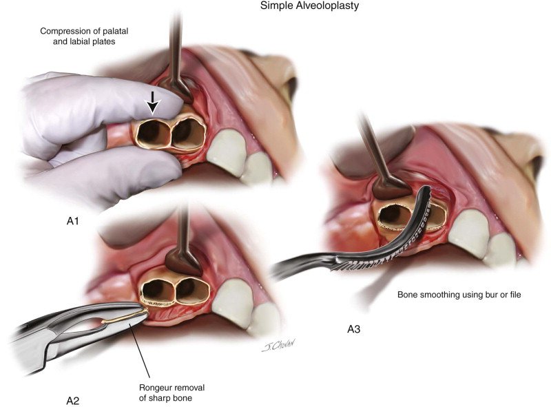 Alveoloplasty per segment