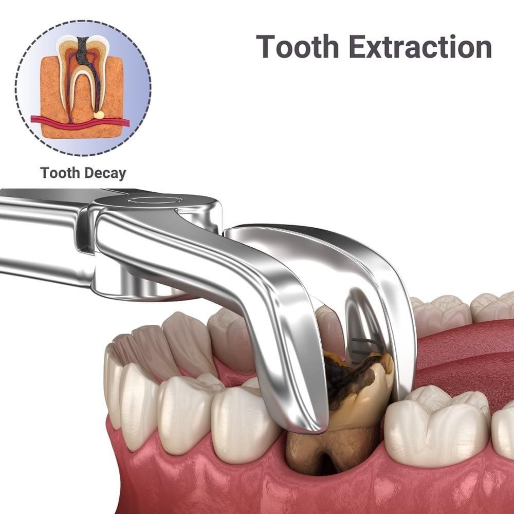 Tooth extraction