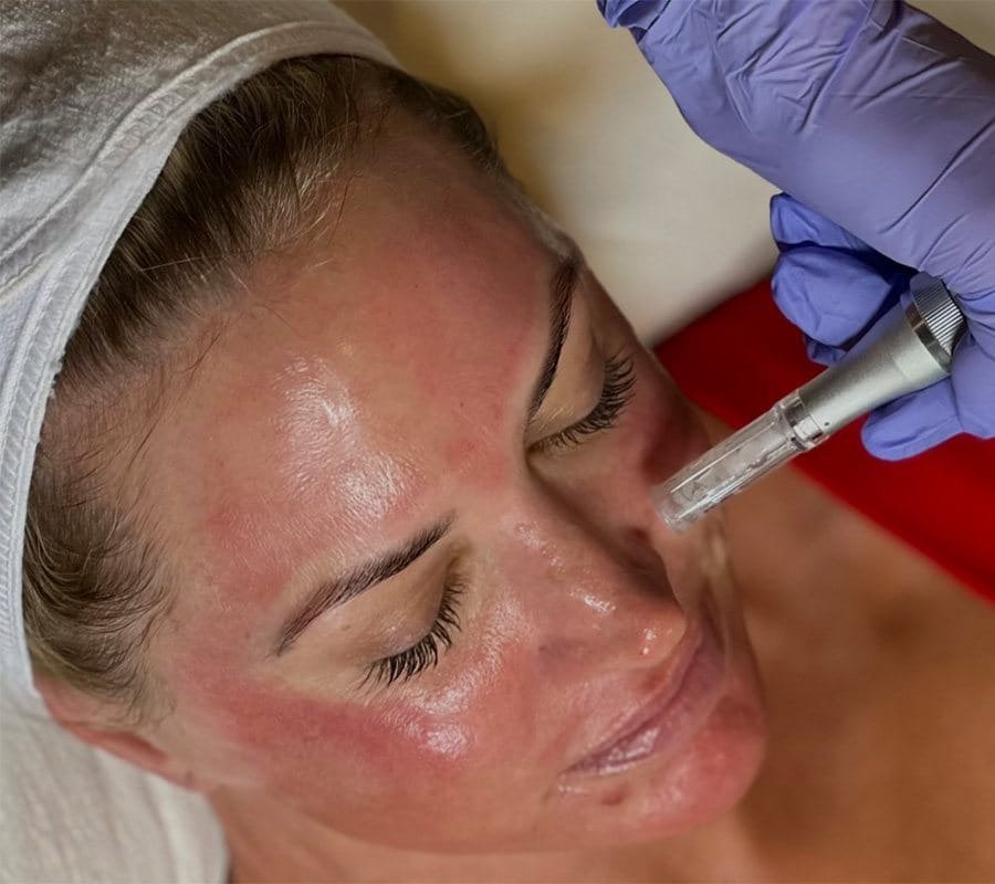 Micro-Needeling face with PRP and PDRN + Growth factors