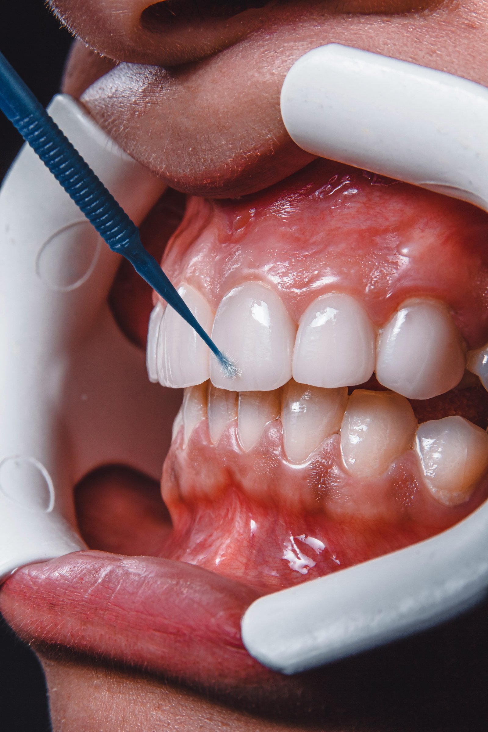 Fluoride Tooth sensitivity treatment