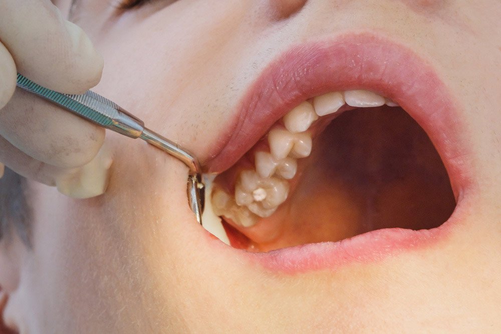 Upper Wisdom Tooth Extraction