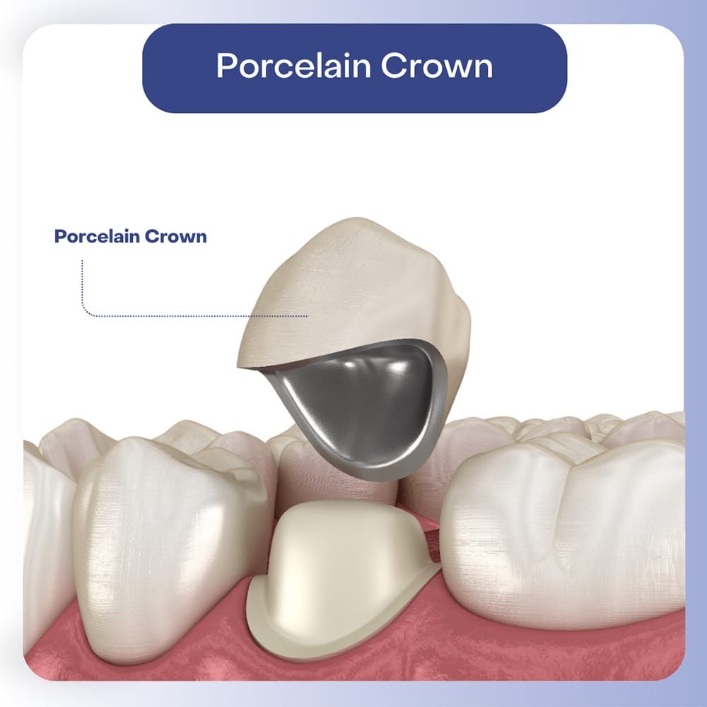 Porcelain Crown (Chinese)