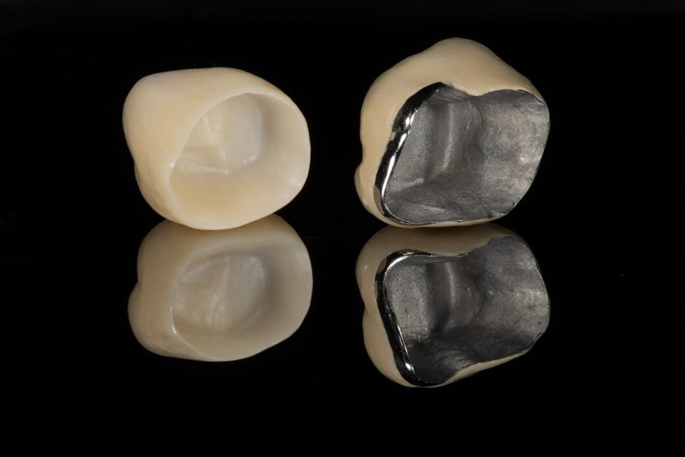 Porcelain Crown (Japanese)