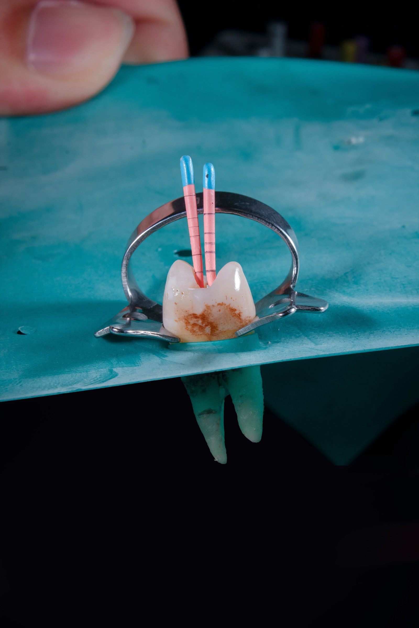 Root Canal