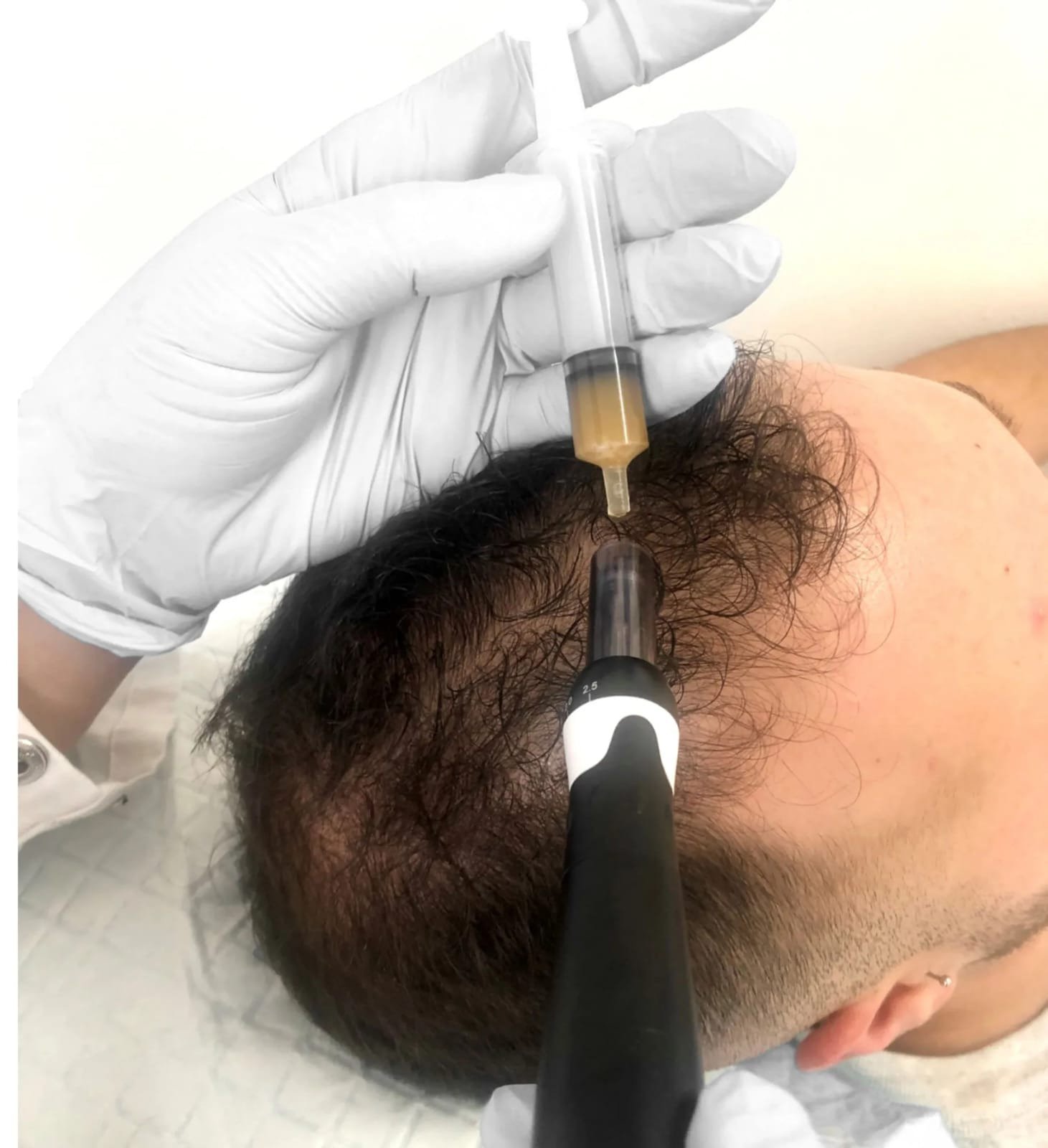 Hair PRP with Micro-Needeling + PDRN + Growth factors