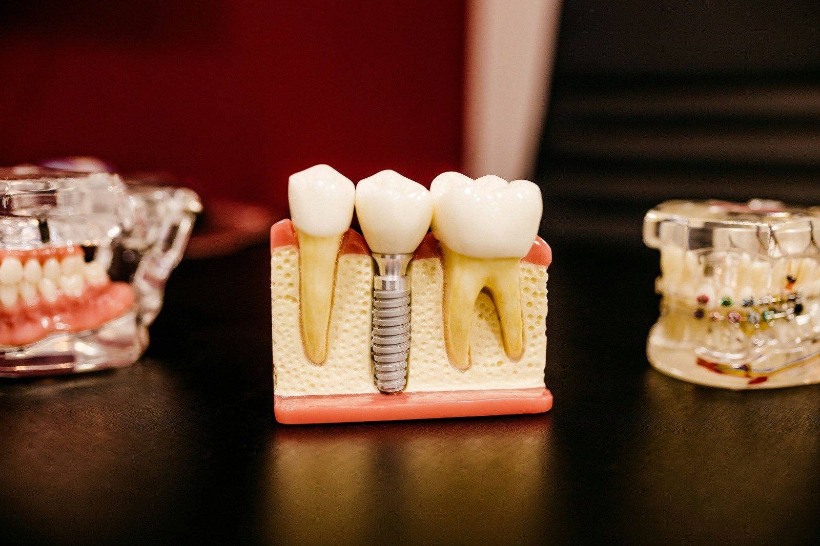 Implant(japanese)