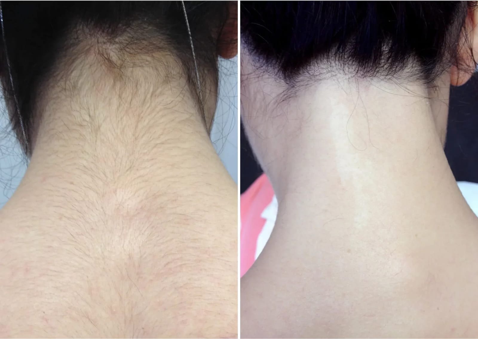 Full Neck back laser