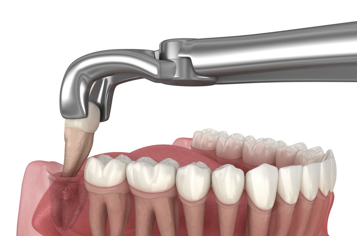 Lower wisdom tooth extraction