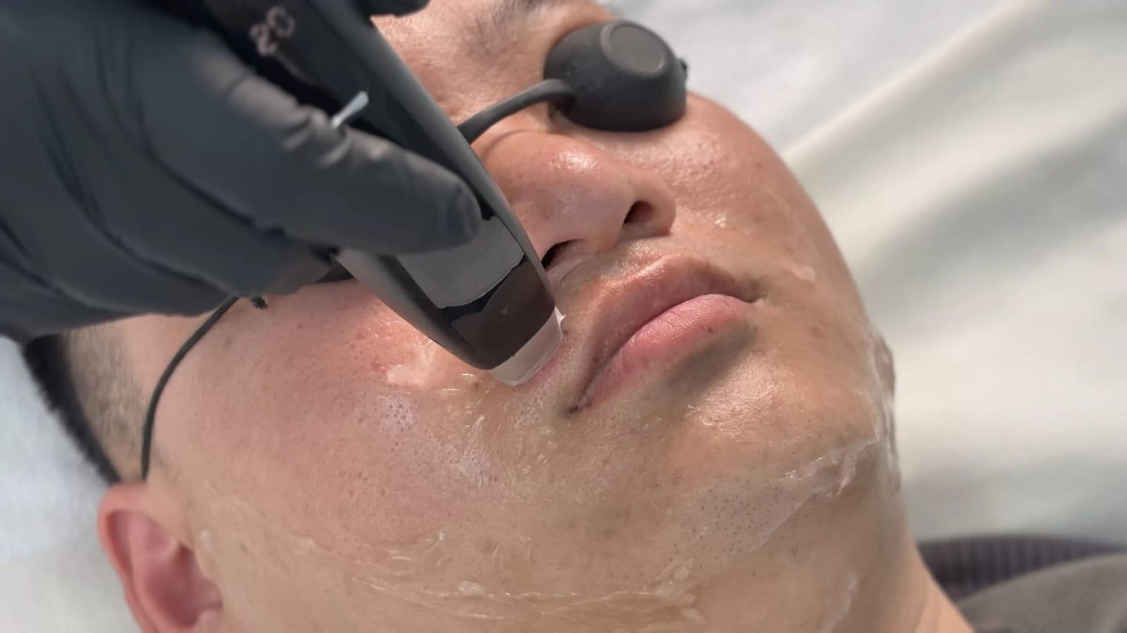 Upper lip and chin